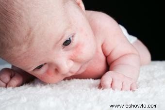 Soluciones naturales para recién nacidos con mejillas rojas secas
