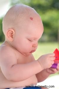 Diagnóstico y tratamiento del hemangioma en bebés
