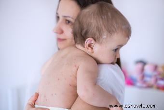 Información esencial sobre la varicela en bebés