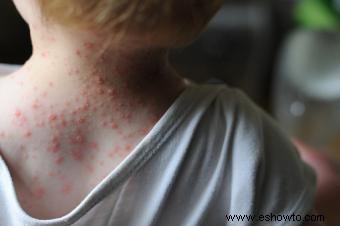 Información esencial sobre la varicela en bebés
