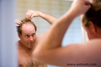 Cinco cosas que hacen los hombres cuando empiezan a perder el cabello
