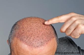 Lidiar con la pérdida de cabello masculina