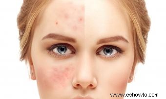 ¿Qué es el acné? 