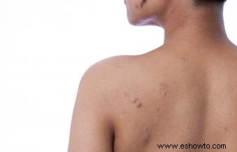 Cómo tratar el acné en la espalda 