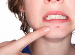 Limpiador Glicólico con Peróxido de Benzoílo: Guía Experta para Tratar el Acné