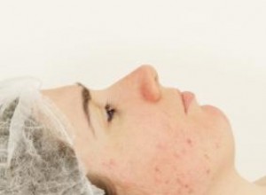 Opciones para cicatrices graves de acné