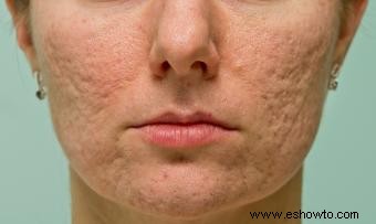 ¿Qué hace que desaparezcan las cicatrices del acné?