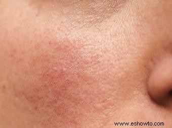 ¿Qué hace que desaparezcan las cicatrices del acné?