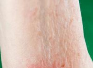 Erupción por Sudoración: Causas, Síntomas, Tipos y Tratamientos Efectivos