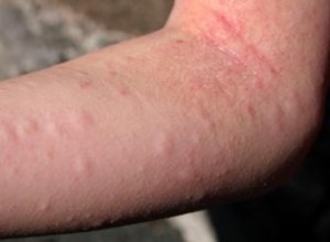 Erupciones Cutáneas por Reacciones Alérgicas: Causas, Síntomas y Cuándo Consultar al Médico