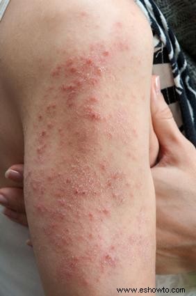 Alergias comunes de la piel