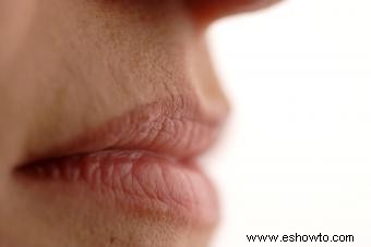 Esquinas de los labios agrietadas