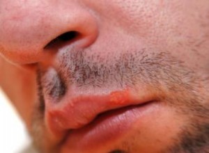 ¿Duelen las ampollas de fiebre? Etapas del dolor, síntomas y consejos para aliviarlas