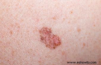 Cinco signos de cáncer de piel