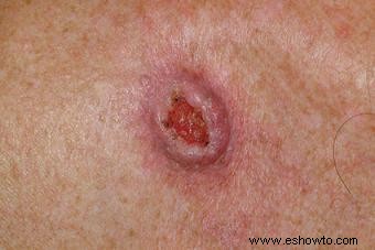 Cinco signos de cáncer de piel