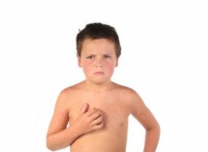 Erupción por Sarampión: Síntomas, Prevención y Tratamiento Efectivo