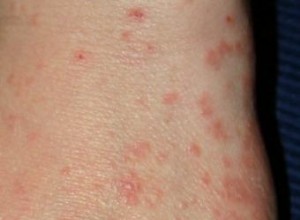 Tratamiento Efectivo de la Sarna: Guía Completa para Eliminarla y Prevenir Recaídas