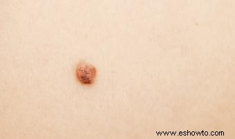 Etapas del melanoma 