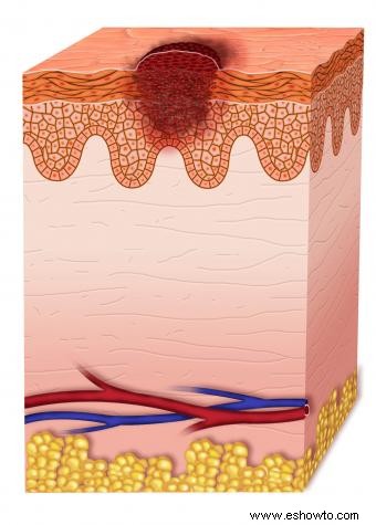 Etapas del melanoma 