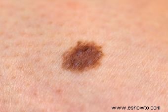 Etapas del melanoma 