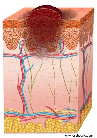 Etapas del melanoma 