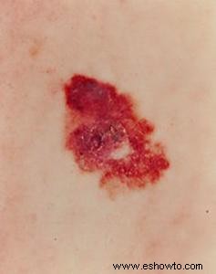 Etapas del melanoma 