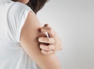 ¿Por qué siguen picando las picaduras antiguas de mosquitos? Causas y tratamientos