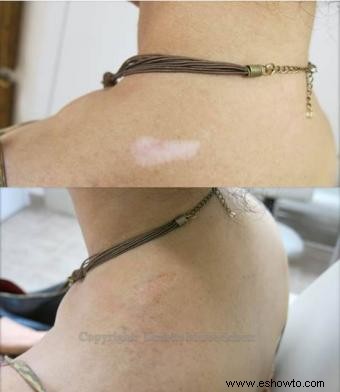 Tatuajes del color de la piel para cubrir cicatrices