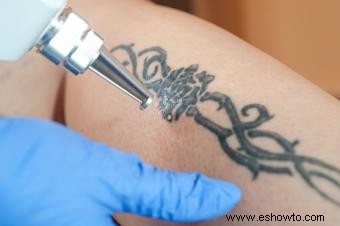Instrucciones de cuidado posterior para la eliminación de tatuajes con láser