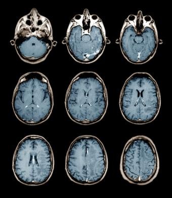 Características físicas del autismo