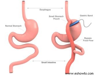 Bypass gástrico versus banda gástrica 