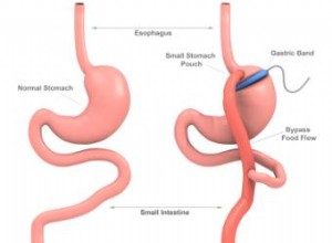 Bypass Gástrico vs. Banda Gástrica: Diferencias, Requisitos y Resultados para Perder Peso