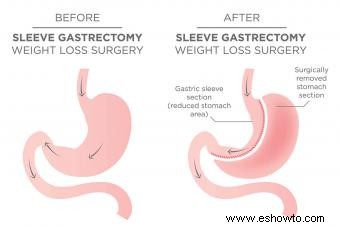 Métodos de pérdida de peso extrema y cómo funcionan 