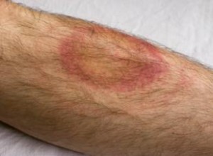 Dieta sin gluten para la enfermedad de Lyme: beneficios, evidencia y recomendaciones