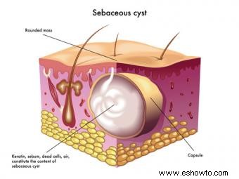 Curas naturales para los quistes sebáceos