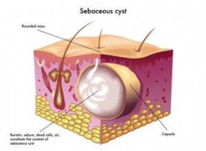 Curas naturales para los quistes sebáceos