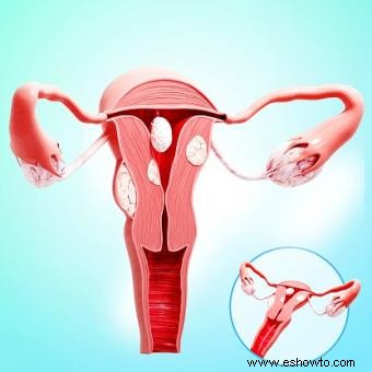 5 causas principales de agrandamiento del útero