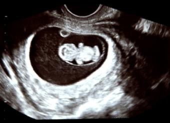 Procedimiento de prueba de amniocentesis, beneficios y riesgos