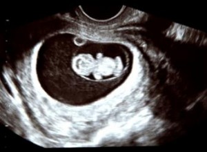 Amniocentesis: Procedimiento Detallado, Beneficios, Riesgos y Cuándo Realizarla