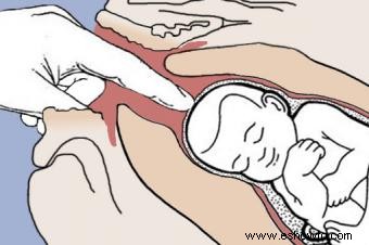 Información vital sobre la extracción de membranas para inducir el parto