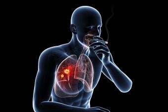 Fumar y cáncer de pulmón