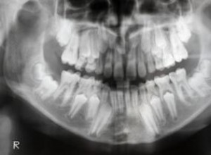 Rastreo EEG del Bruxismo: Conexiones con Ciclos de Sueño y Salud Cardiovascular