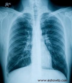 Edema pulmonar y BiPaP