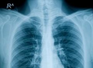 Edema Pulmonar y BiPAP: ¿Es una Combinación Segura y Efectiva?