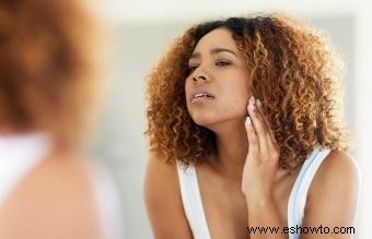 Cómo reconocer el acné por estrés y cómo combatirlo