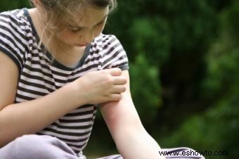 ¿Puede el estrés causar urticaria?