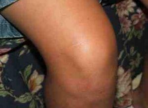 Los Mejores Suplementos para Aliviar el Dolor de Rodilla: Glucosamina, Condroitina y Más