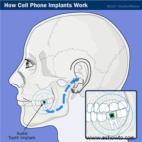 Cómo funcionan los implantes de teléfonos celulares 